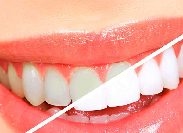 Blanqueamiento dental: quÃ© tener en cuenta antes y despuÃ©s